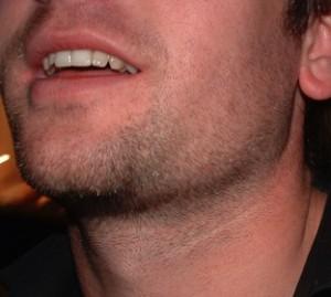 scruff Lose the unwanted scruff without fear of razor burn!