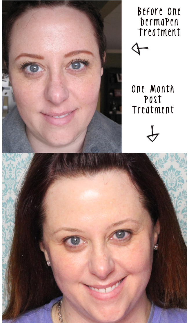 DermaPen, anti-aging, non-invasive, before and after
