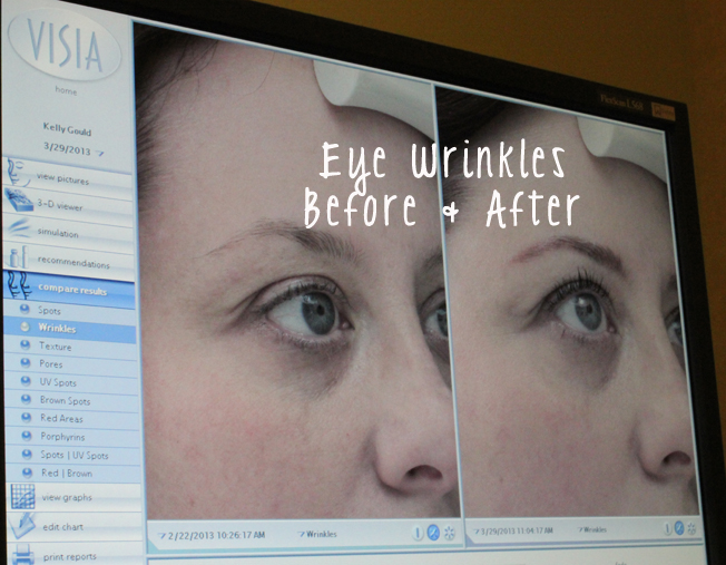 DermaPen, anti-aging, non-invasive