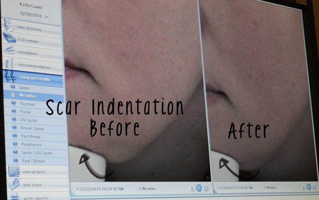 DermaPen, anti-aging, non-invasive, before and after