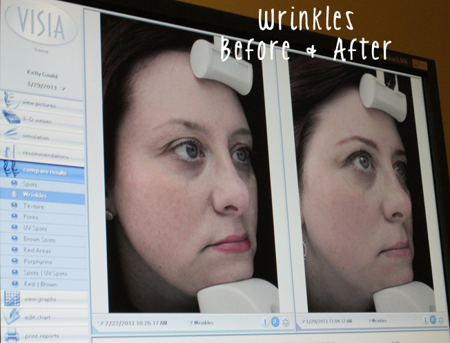 DermaPen, anti-aging, non-invasive, before and after