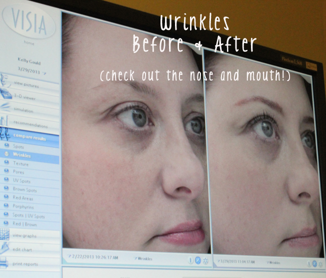 DermaPen, anti-aging, non-invasive